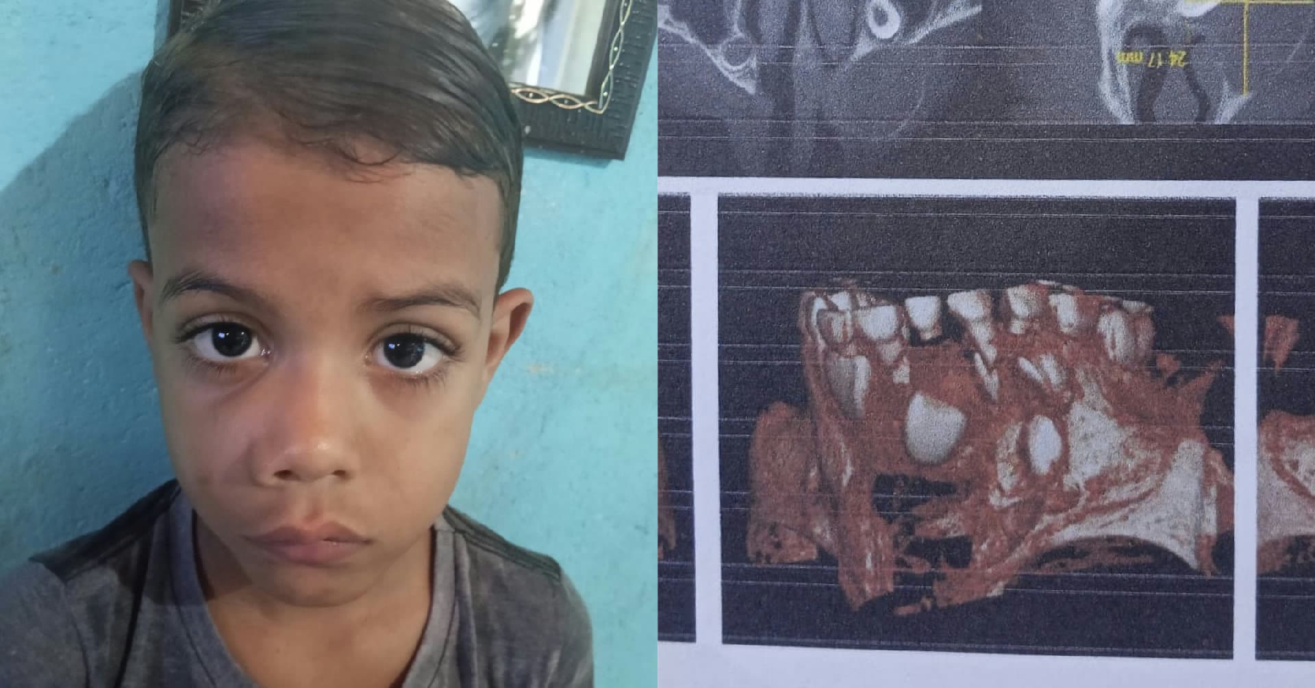 Criança pequena em ambiente hospitalar representando campanha solidária para cirurgia