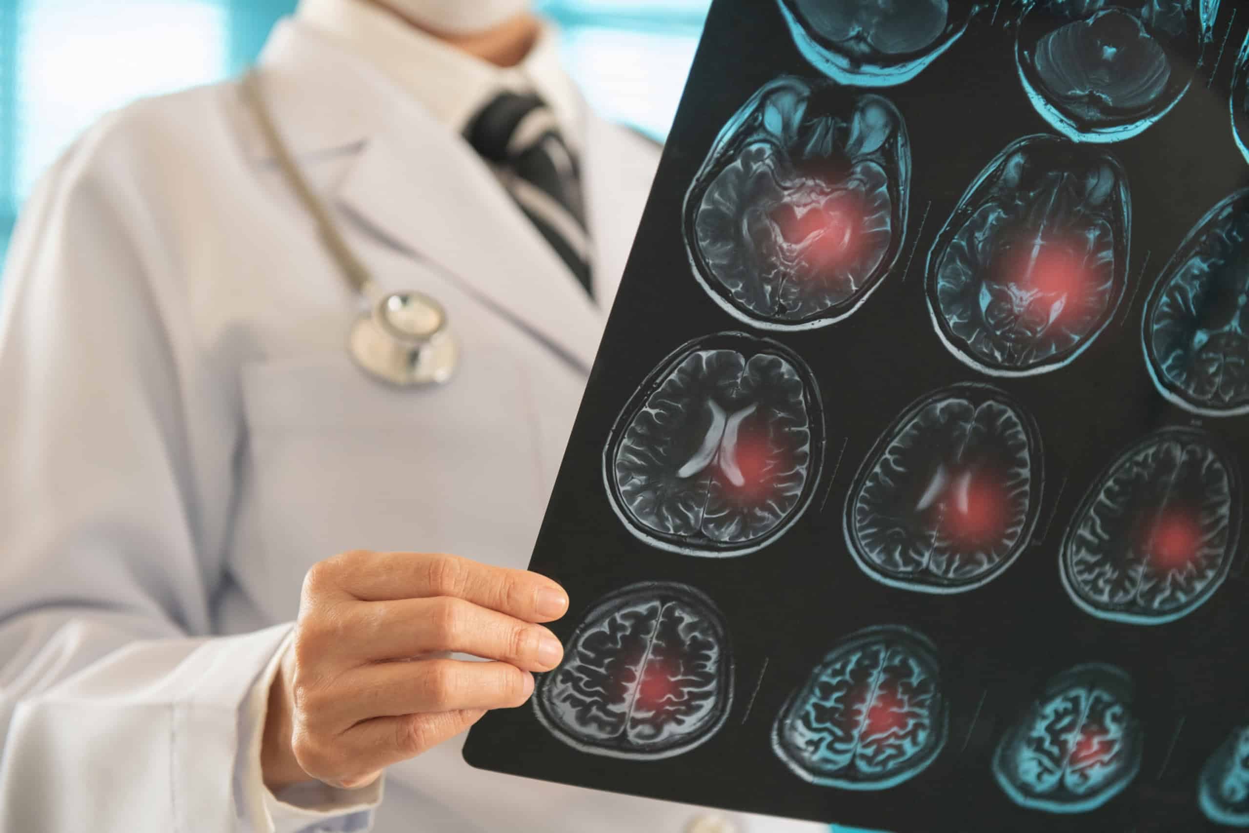 Casos de AVC crescem entre jovens brasileiro (Imagem: utah778/iStock)