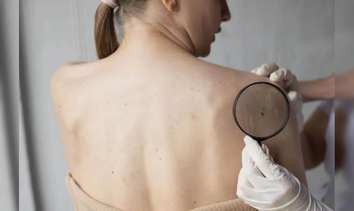 Mutirão de prevenção e detecção de câncer de pele é realizado na Bahia.