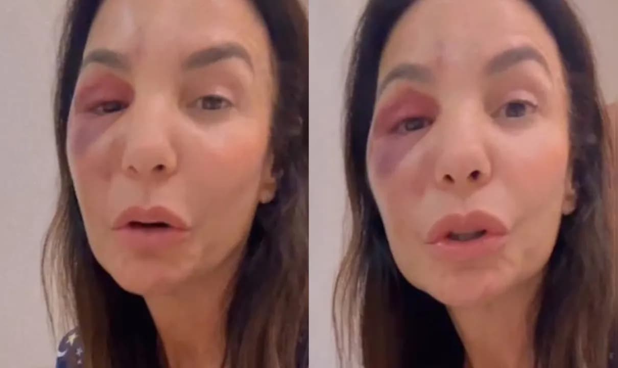 Cantora fez a 1ª aparição após passar por cirurgia de sete horas para colocar osso de volta no rosto.