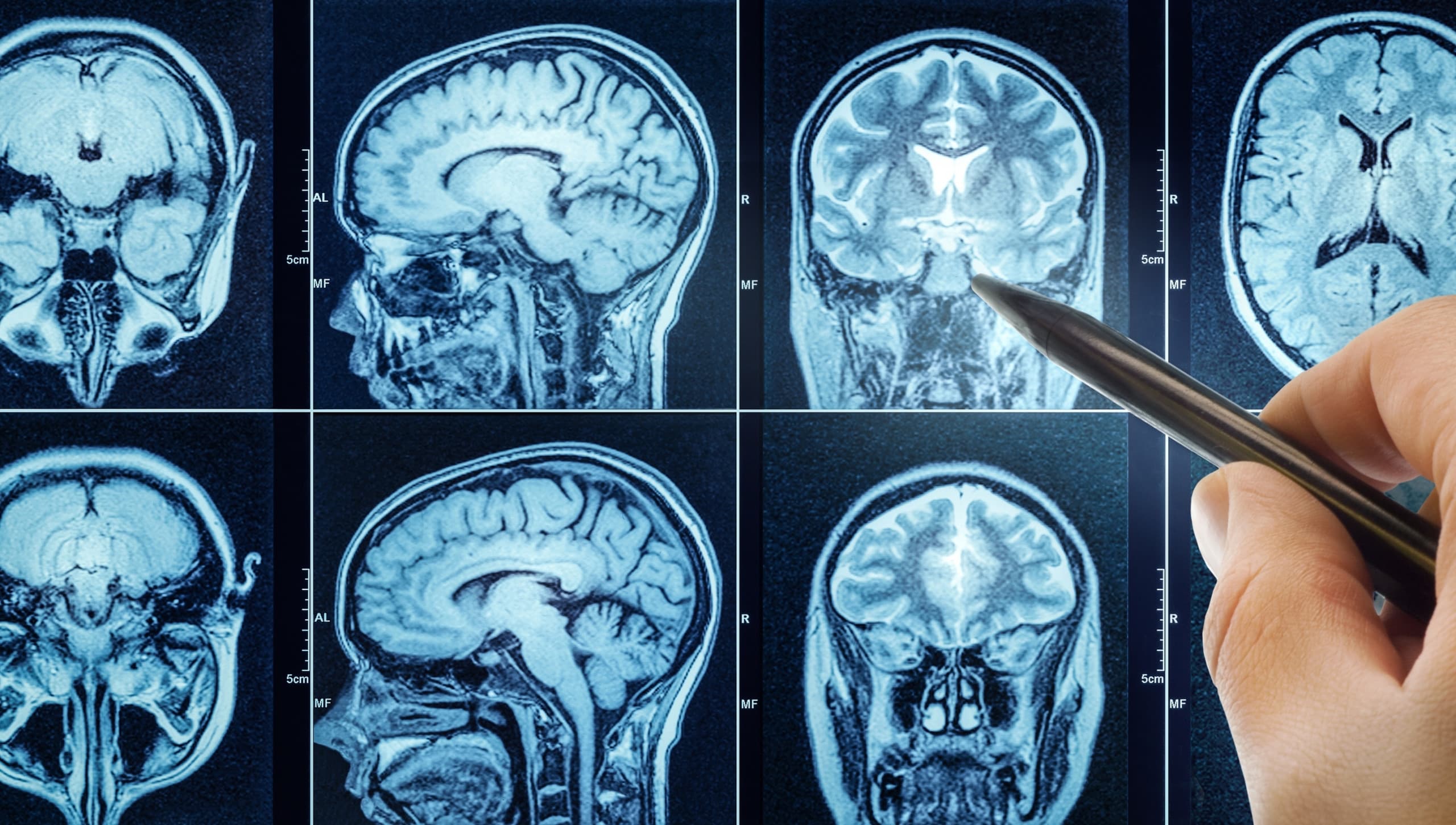 Hidralazina, usada há 70 anos contra pressão alta, revela mecanismo que pode ajudar no combate a câncer cerebral (Imagem: Triff / Shutterstock)