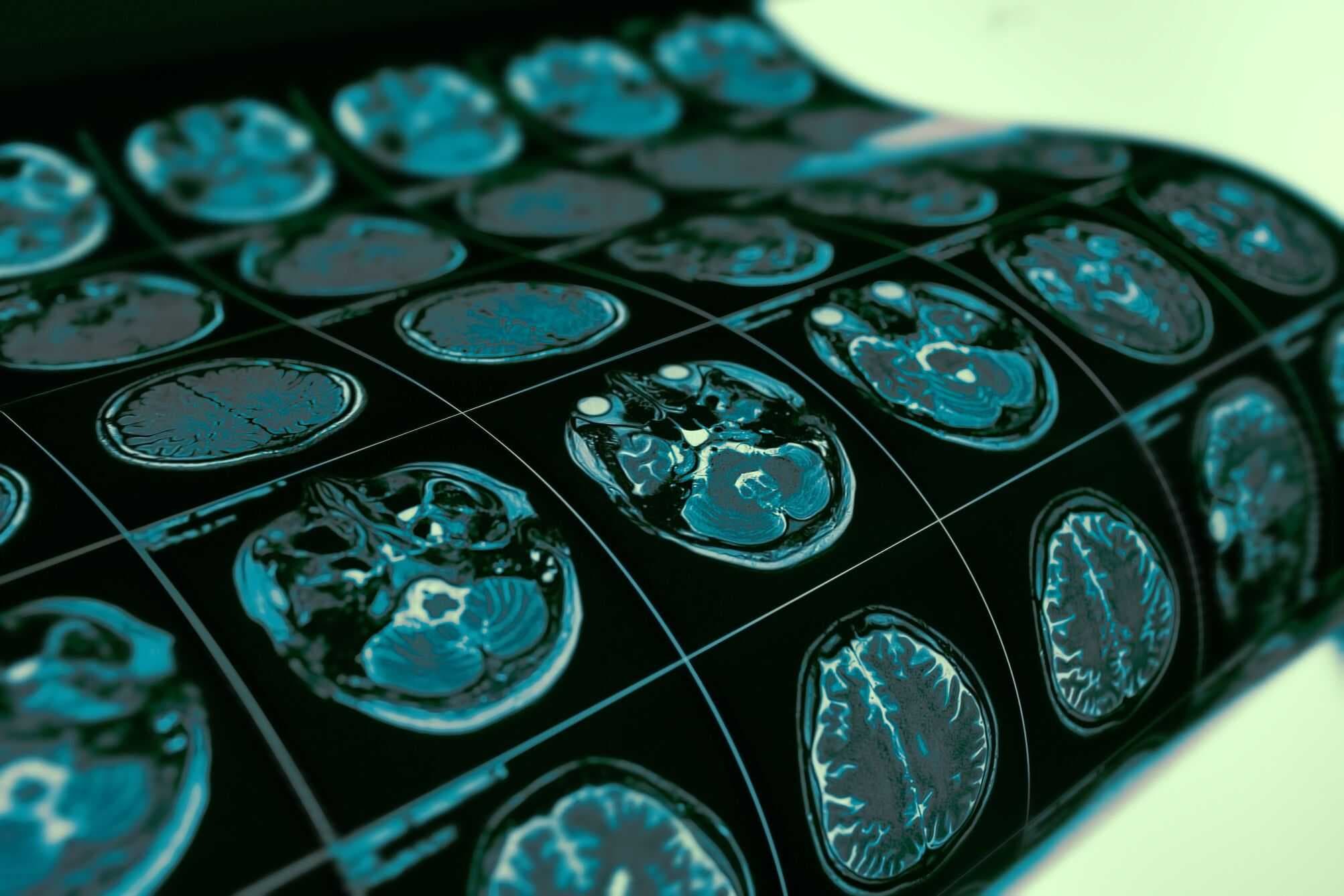 Pesquisas recentes sugerem que muitos transtornos psiquiátricos surgem primeiro como alterações localizadas no cérebro e, depois, se expandem para outras áreas por meio de redes de conectividade (Imagem: sfam_photo/Shutterstock)