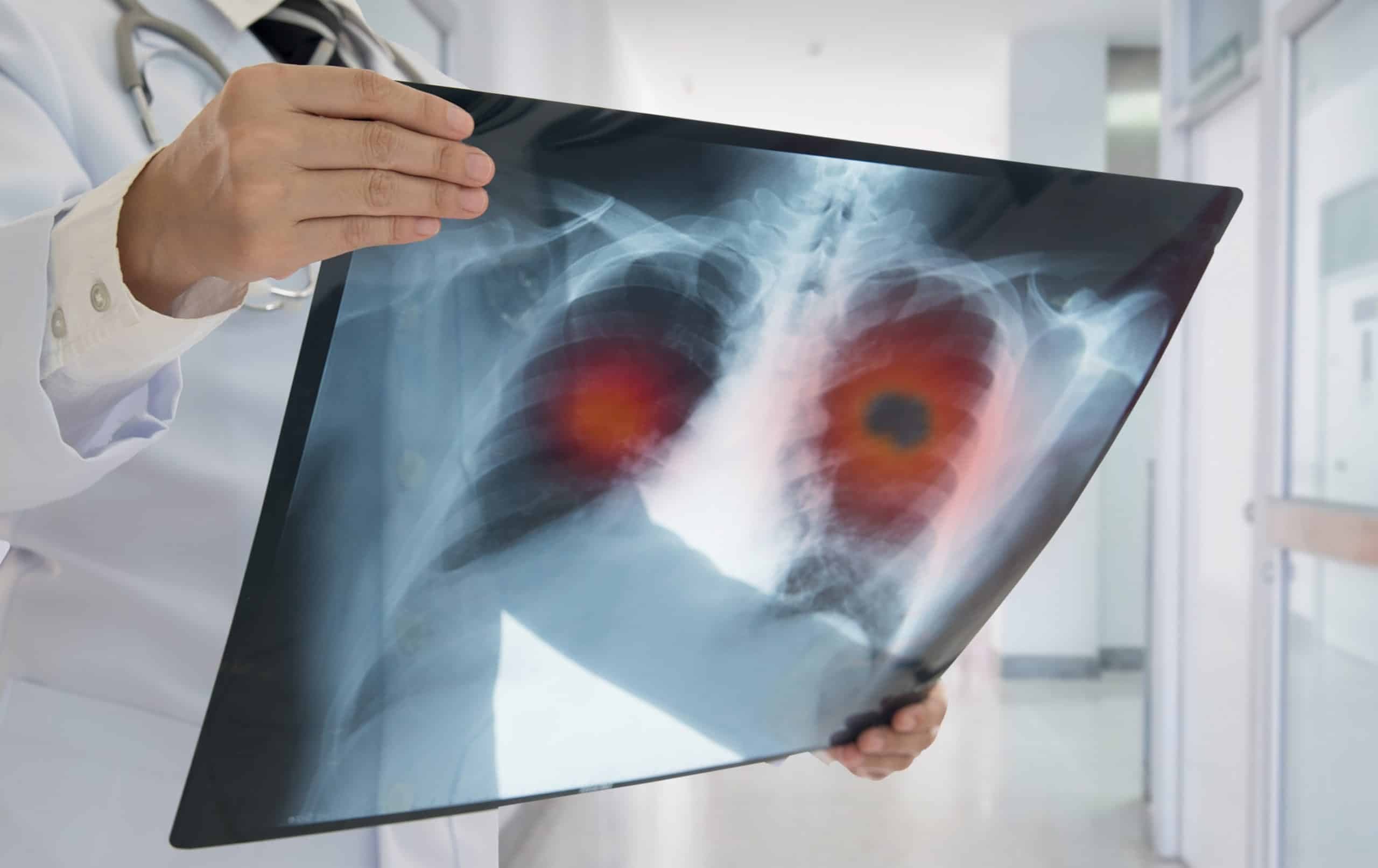 Raio-x de câncer de pulmão (Imagem: utah778/iStock)