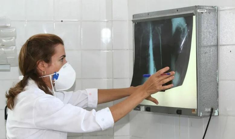 Aumento De Casos De Tuberculose No Brasil Preocupa Especialistas