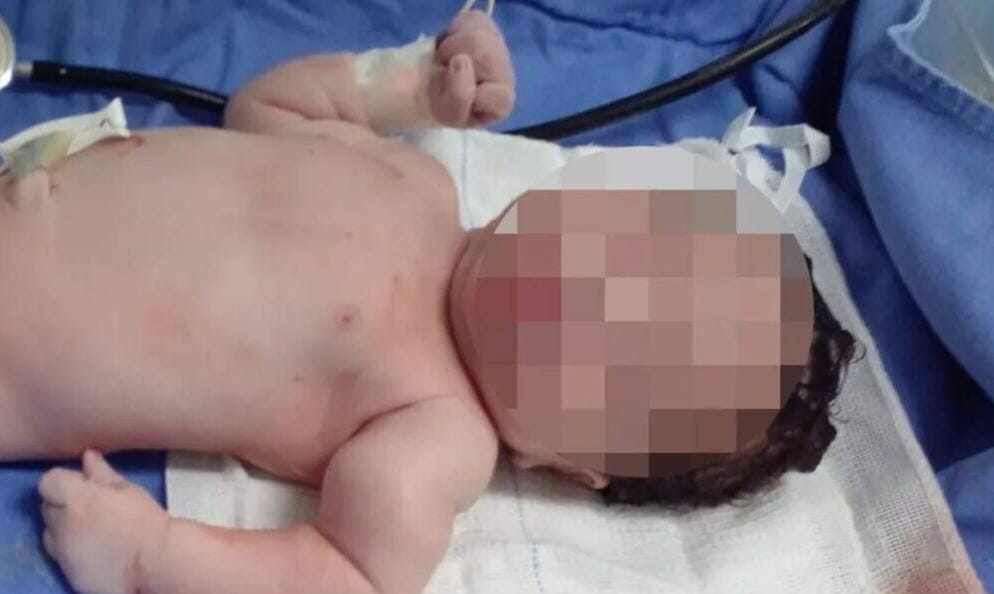 Bebê Tem Braço Quebrado Durante Parto Em Maternidade De Salvador; Pai Acusa Médicos 
