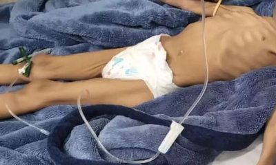 Menina De 3 Anos Resgatada Após 40 Dias Sem Comer, Pai É Preso Por Negligência Em Sp